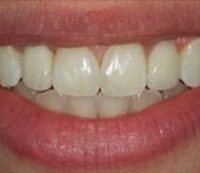 implant-before-and-after2-1-e1599816888673-200×173