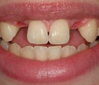 implant-before-and-after2-e1599816841685-200×173