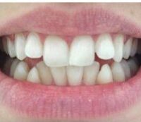 invisalign-results1-e1599816996338-200×173