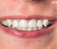 root-canals-2-1-e1599814729865-200×173