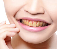 story_1_before-200×173