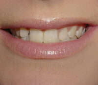 veneers3-e1599814901267-200×173